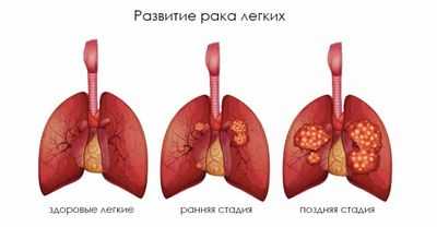 Двойной удар: РНКи усиливает терапию рака легких