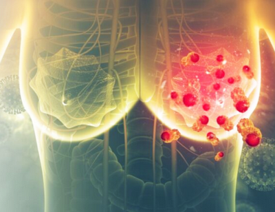 Новый подход в лечении рака груди