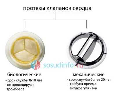 Сердечные клапаны, сделанные из ткани, а не из металла, могут быть лучше для пациентов среднего возраста Сердечные клапаны, сделанные из ткани, а не из металла, могут быть лучше для пациентов среднего возраста