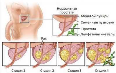 Новые биомаркеры рака простаты у не чернокожих